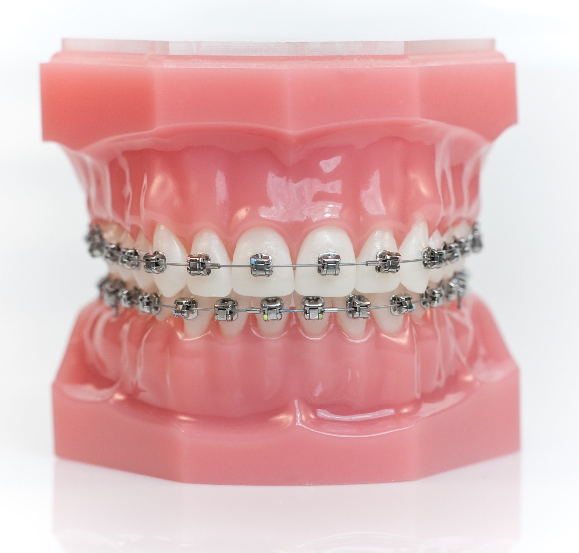 Metal Braces Las Vegas Orthobar