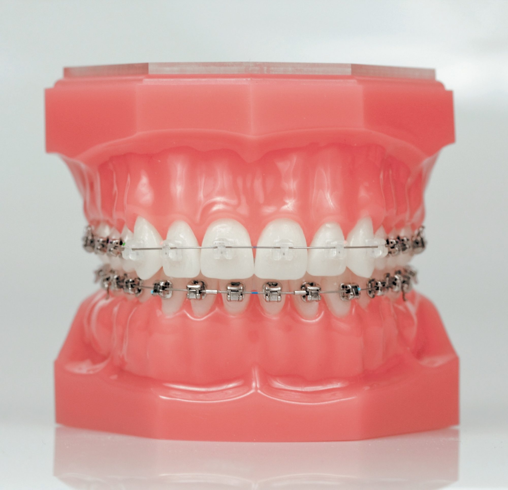 A picture of teeth being displayed with Damon clear braces on the teeth.