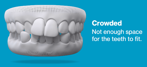 3d model of crowded teeth