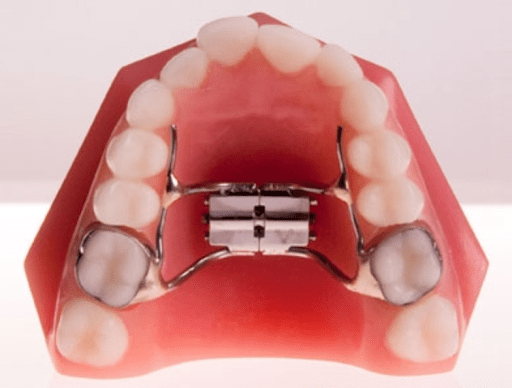 palatal expander on model teeth