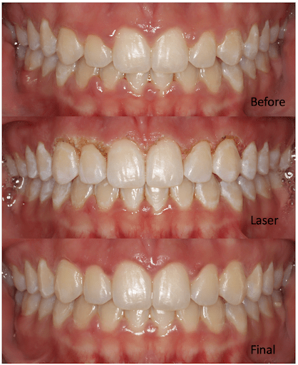 before and after orthodonic laser treatment of mouth closed