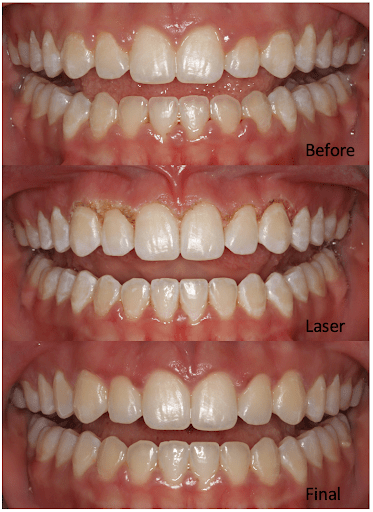 before and after orthodonic laser treatment of mouth open