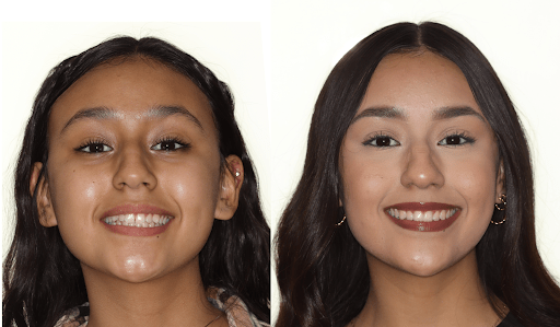 before and after orthodonic treatment images of young girl 