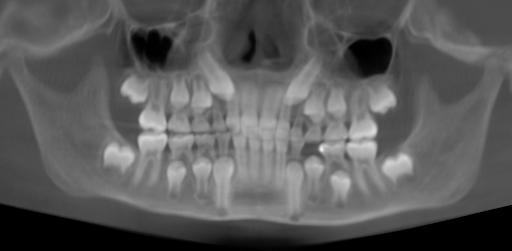 xray of impacted upper adult canines