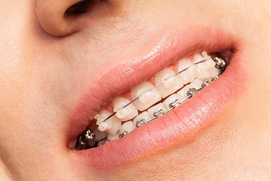 Mouth with clear braces and metal braces on teeth.