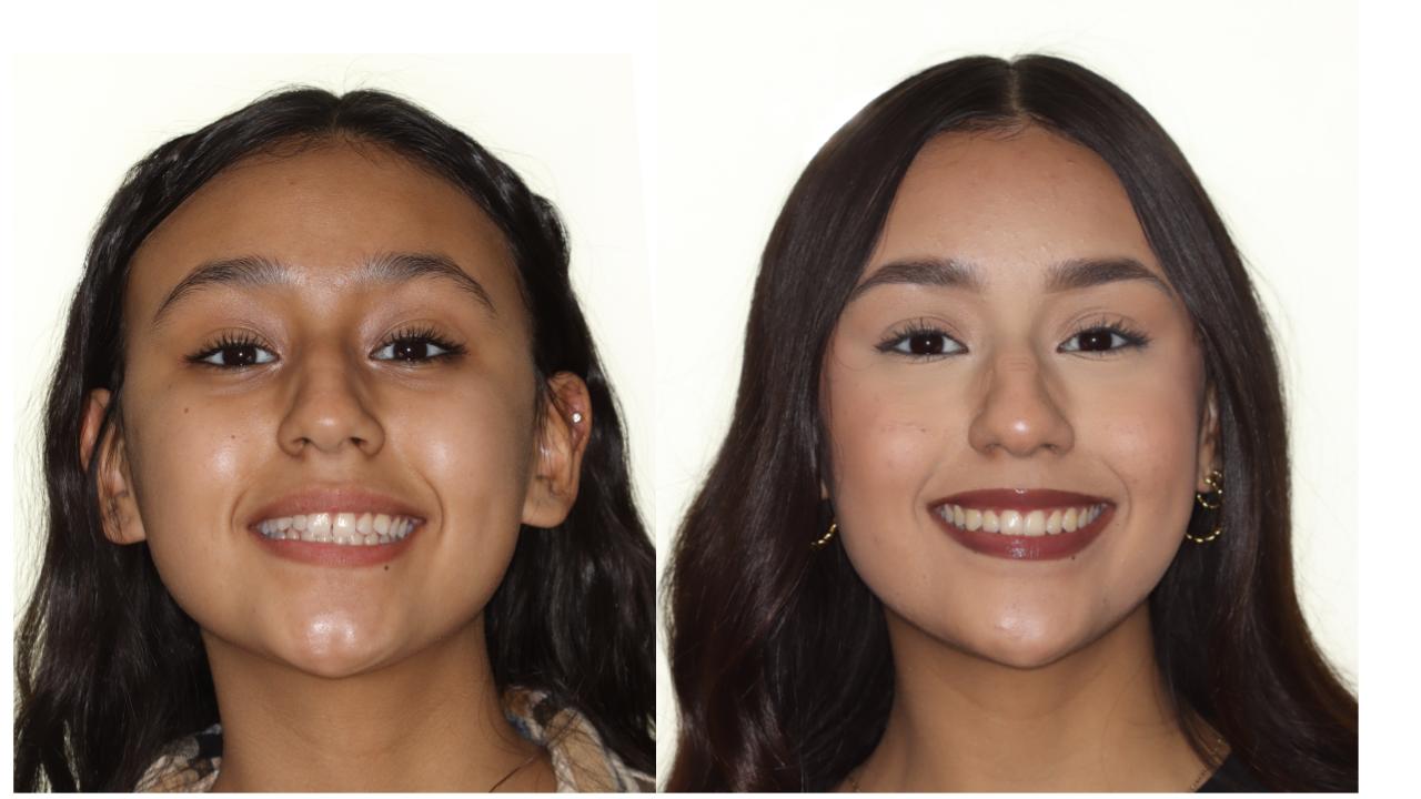 Orthodontic treatment female patient before and after photo.