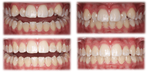 Orthodontic treatment closed mouth before and after photo