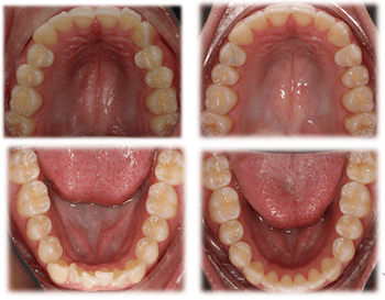 Orthodontic treatment open mouth before and after photo