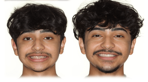 Orthodontic treatment male patient before and after photo.