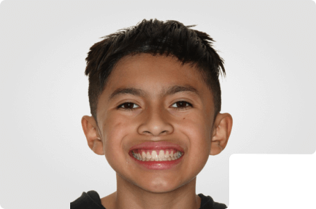 A kid smiling with straight white teeth after finishing metal braces treatment.