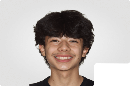 A teen boy smiling with straight white teeth after finishing metal braces.