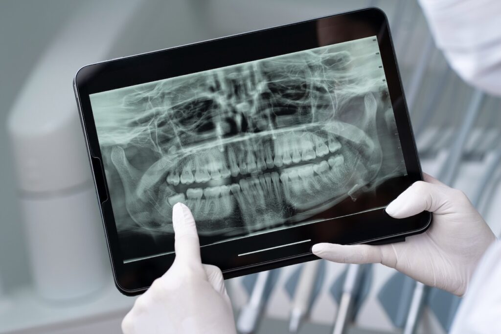 Xray of teeth and jaw of an orthodontic patient
