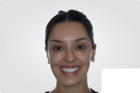 Bianca- Adult INVISALIGN Aligners
