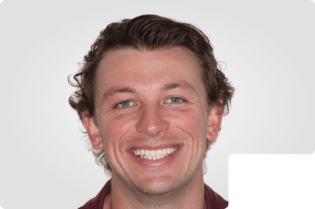 Ian- Adult SPARK Aligners