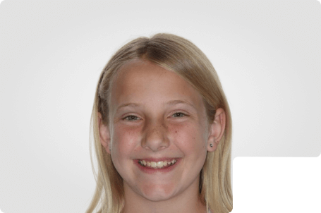 MeKenna- Kids Braces
