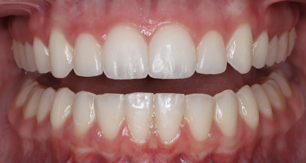 Results of an Orthobar smile makeover