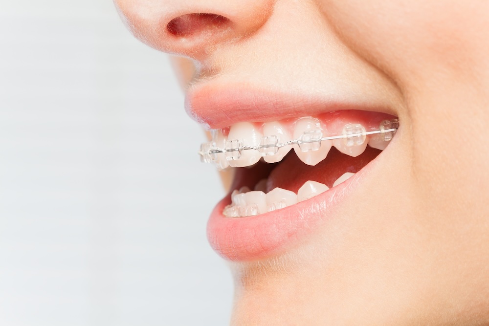 Close up side view of a smiling woman wearing ceramic braces.